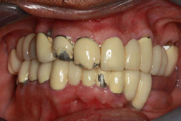 Before full mouth reconstruction